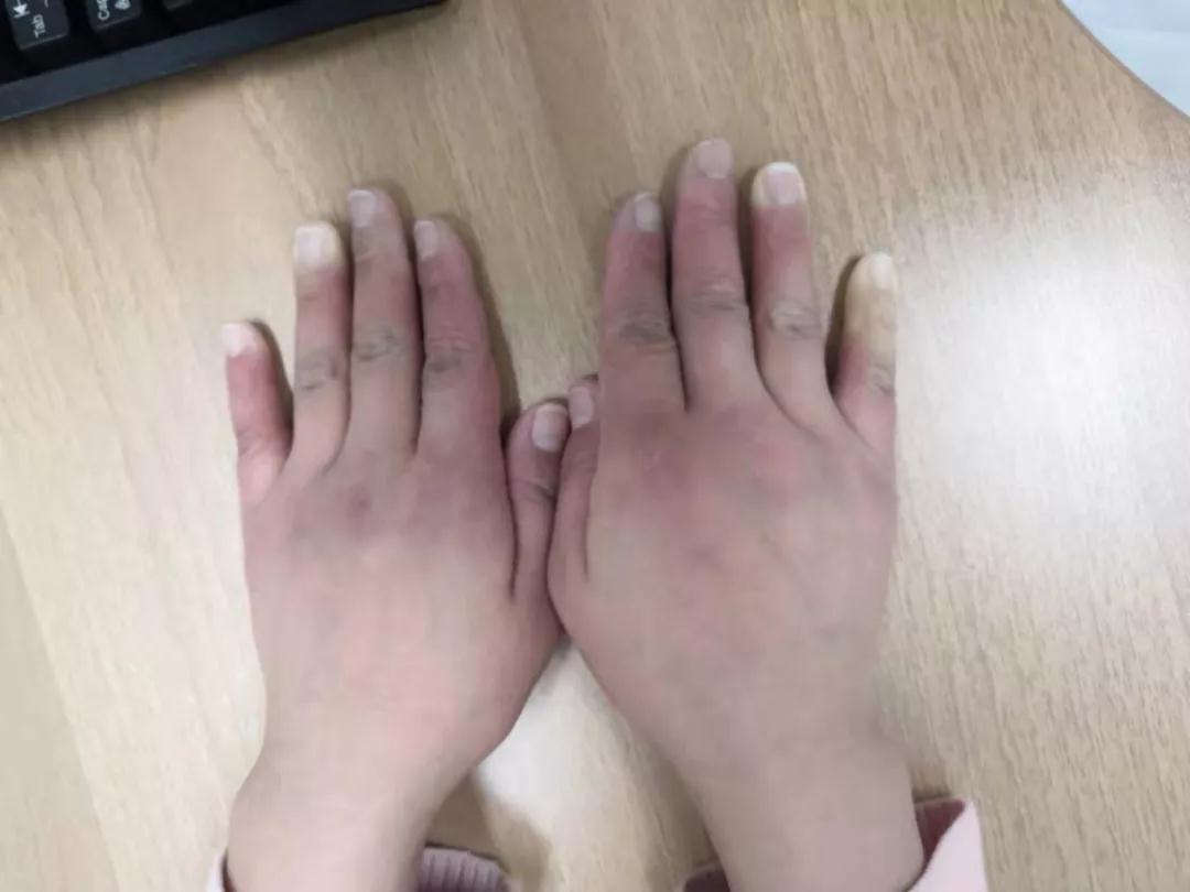 “手指、腳趾發(fā)白、發(fā)紫……”這些“小毛病”千萬(wàn)別大意