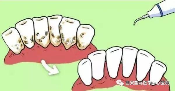 【科普】牙齒上的黃斑好難看，三招告訴你如何預防氟斑牙