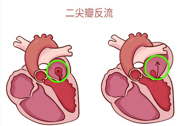 體檢報(bào)告里的心臟瓣膜返流，你讀懂了嗎？
