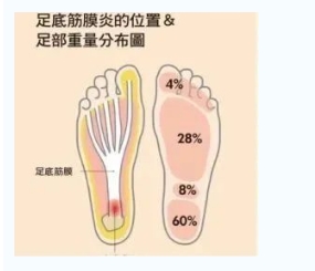 每年新生數(shù)百萬足底筋膜炎患者！國際醫(yī)學專家提醒：跑步要選擇合適的鞋